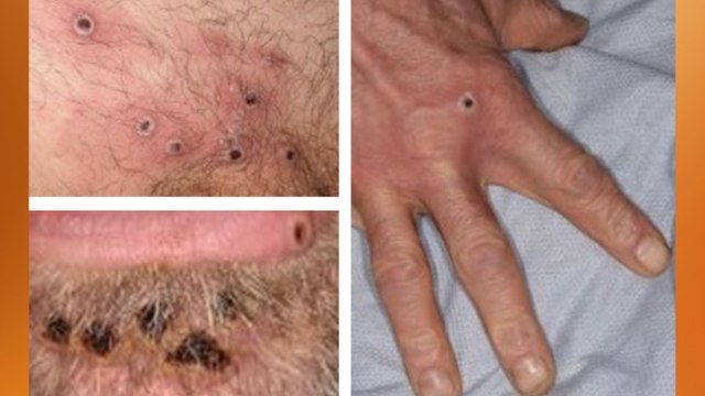 Mpox: Fifth UK Case detected in Leeds - What are the symptoms and how is an infected person treated?