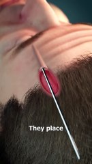 How This Forehead Lift Works 😮