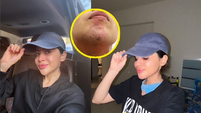 Urfi Javed Removes Chin Fillers After 9 Years, Long Term Side Effects...| Boldsky