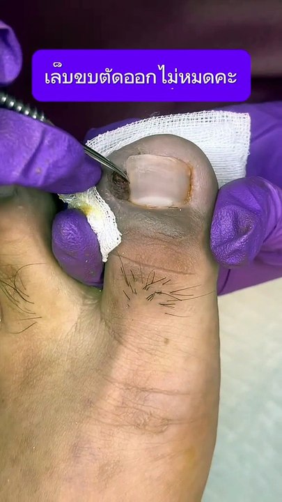 How to cut Ingrown toenail cut treat and not all nails removed