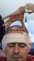 Inside Turkey's hair transplant tourism industry