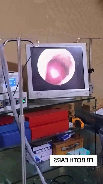 Ear Wax Removal