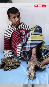 El extraño síndrome del hombre árbol ¿Qué es y cómo afecta a quienes padecen esta enfermedad?