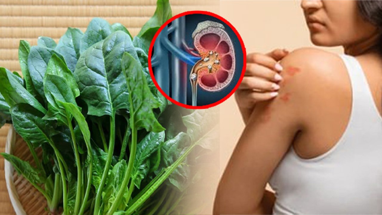 Spinach Side Effects: Palak Khane Se Kya Hota Hai, Kidney Stone, Arthritis Or Thyroid..| Boldsky