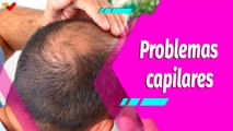 Buena Vibra | ¿Alopecia o calvicie? Descubre los secretos escondidos detrás de este padecimiento