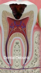 Root canal treatment