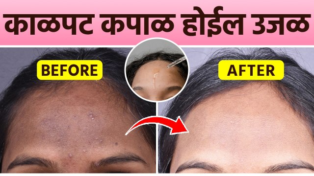 काळपट कपाळासाठी Serum | Serum for Forehead Pigmentation | Remedies For Dark Pigmentation