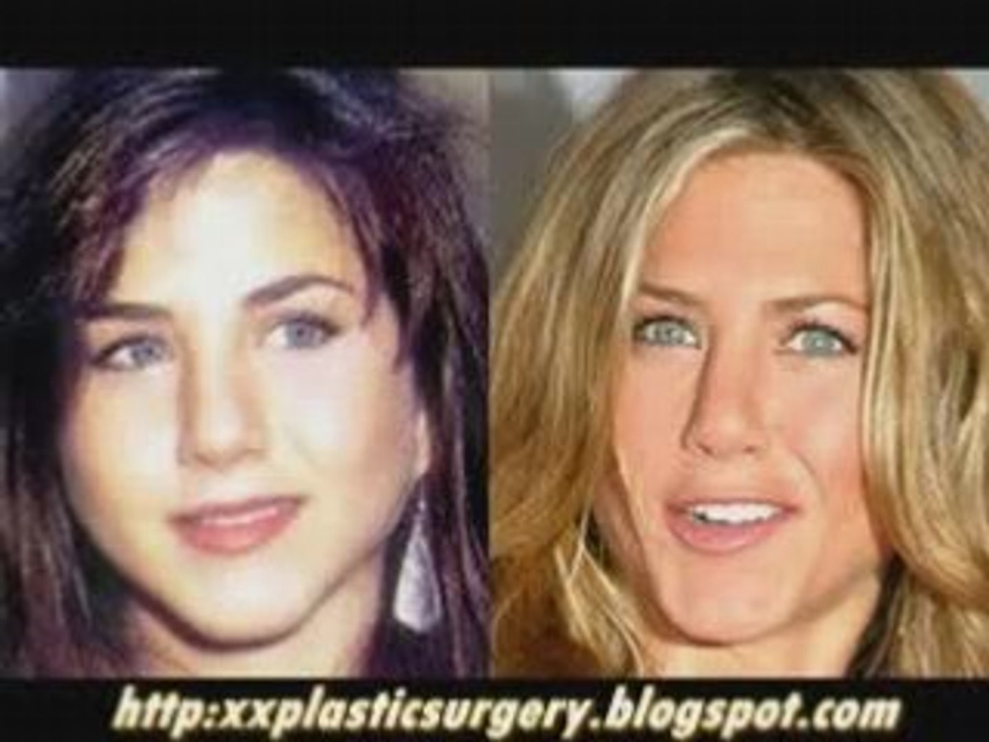 Plastic Surgery Before And After #6