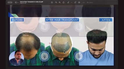 Detailed Knowledge About Cost of Hair Transplant in India by Doctor _ हेयर ट्रांसप्लांट का खर्चा