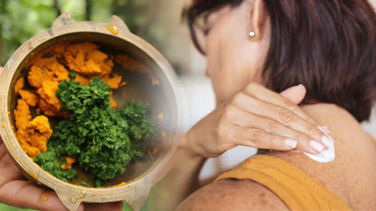 Urticaria Home Remedy Treatment: नीम से पित्त क...