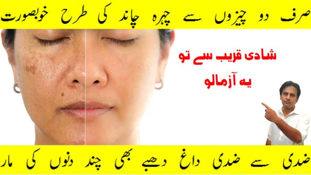 Pigmentation solution on face at home | Home remedy for pigmentation in Hindi | Arshad health and beauty tips