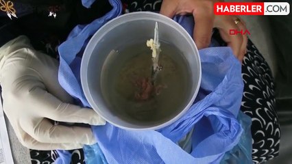 Baş ağrısı şikayetiyle gitti, karnından 16 cm uzunluğunda makas çıktı