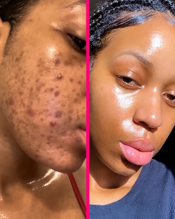 Stopping McDonald's cured this influencer's acne ✨