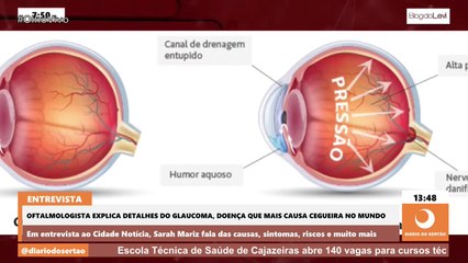 Oftalmologista explica detalhes do glaucoma, doença que mais causa cegueira no mundo