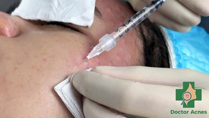 Tiêm meso căng bóng: Giải pháp làm đẹp cho làn da