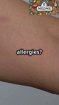 Simple Home Remedies for Skin Allergies