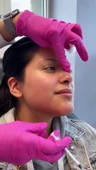 Liquid Rhinoplasty Offers a Subtle, Beautiful Transformation