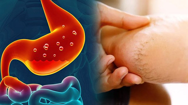 पेट खराब होने से एड़ियां फटती है क्या | Does Gut Health Cause Cracked Heels, FACT CHECK