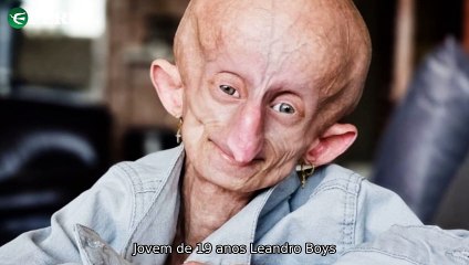 "Jovem com progeria, trend de skincare noturna e recuperação de Ravi: últimas notícias impactantes!"