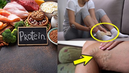 Protein Deficiency Symptoms: प्रोटीन की कमी से क्या होता है, Protein Deficiency Disease Name|Boldsky