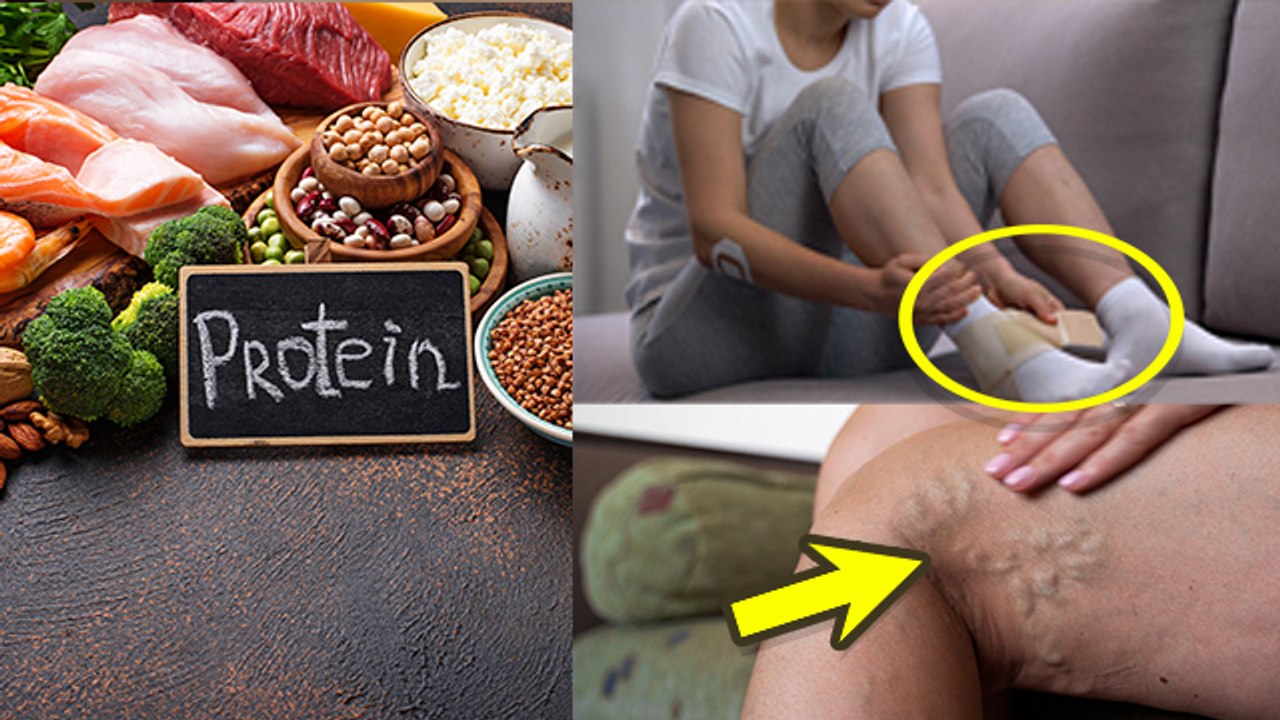 Protein Deficiency Symptoms: प्रोटीन की कमी से क्या होता है, Protein Deficiency Disease Name|Boldsky