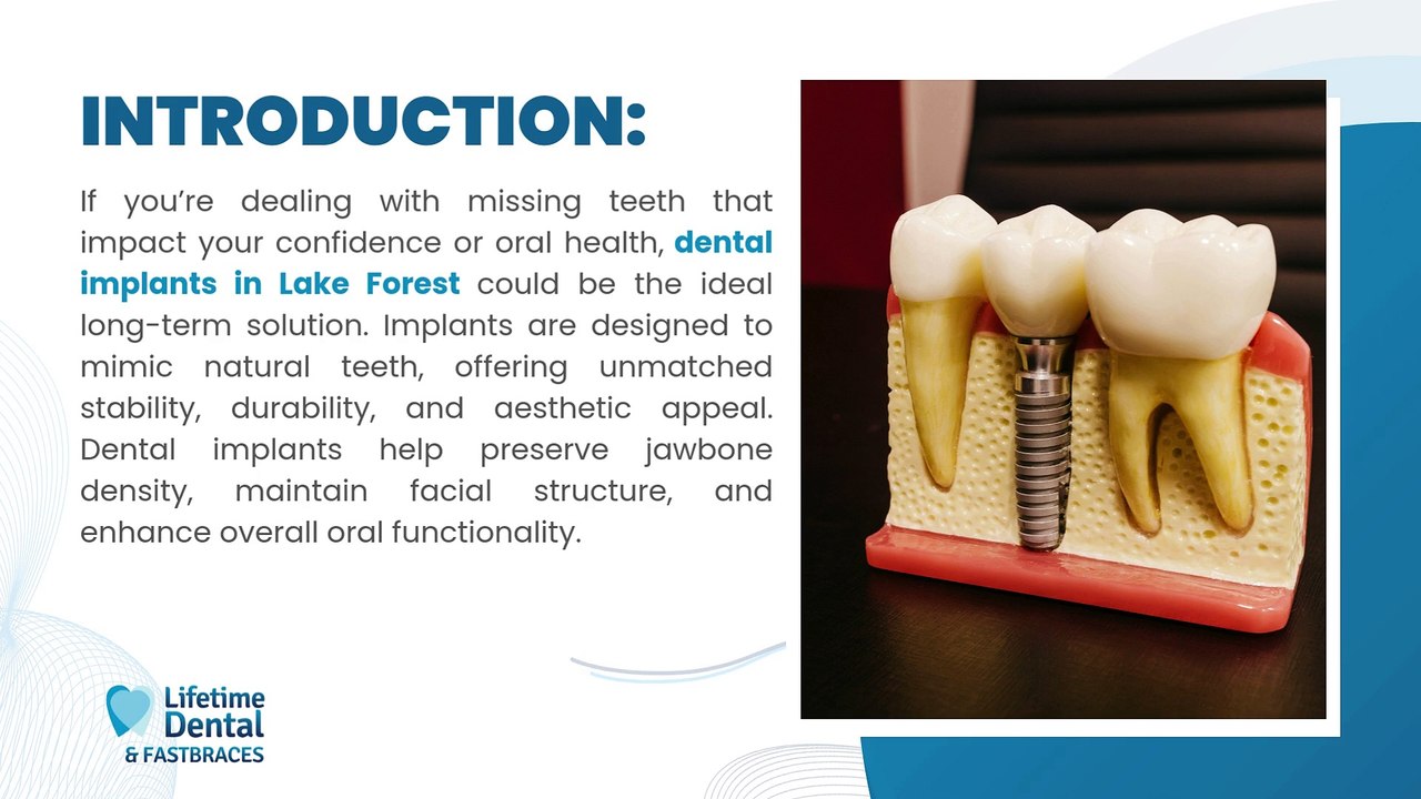 Top Five Benefits of Choosing Dental Implants in Lake Forest