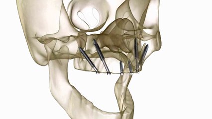 all-on-6-implant İmplant diş fiyatları