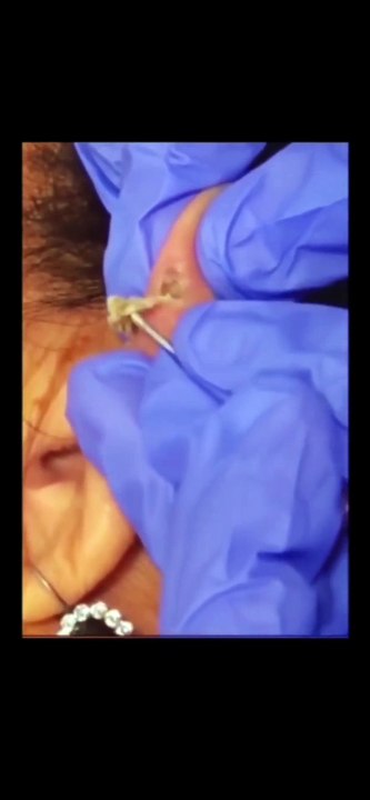 Nose Blackhead Extraction ASMR - Close Up!