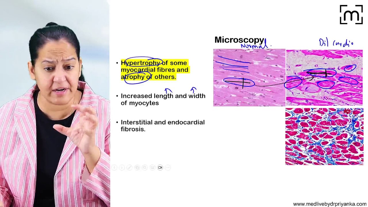 6. Cardiomyopathies