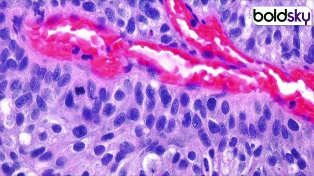 Urinary Catheters Kab Lagta Hai : पेशाब की थैली कब कब लगती है, UTI से लेकर Bladder Cancer तक में