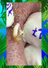 ASMR Blackhead Squeezing Compilation: Extreme Pore Cleansing!