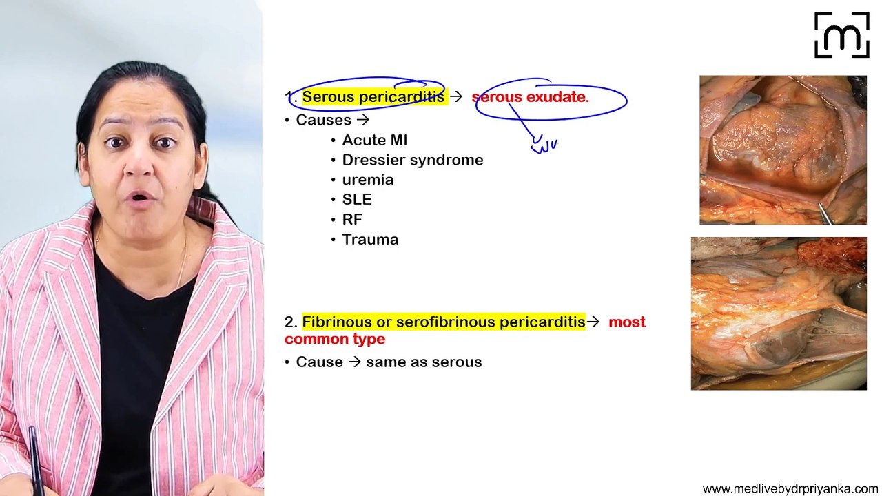 7. Pericarditis