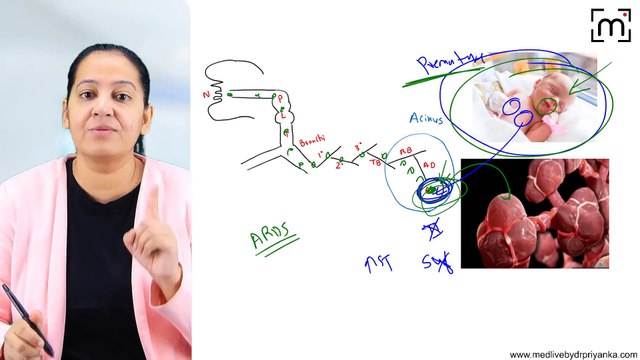 2. Acute Respiratory Distress Syndrome (ARDS)
