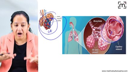 3. COPD - Chronic Bronchitis