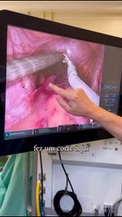 SC faz primeira cirurgia de redesignação sexual com técnica de robótica no Brasil
