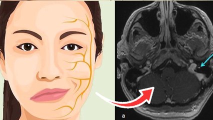 Face Paralysis In Winter: सर्दी में फेस पैरालिसिस का खतरा, Symptoms & Causes In Hindi | Boldsky