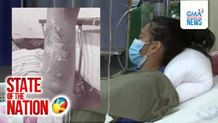 13-anyos na babae, wasak ang kamay matapos masabugan ng 5-star | SONA