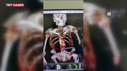 Yüksek riskli ameliyatla 30 yıllık kamburundan kurtuldu