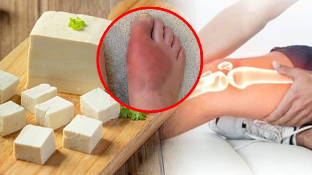 Paneer In Arthritis: गठिया में पनीर खाने से क्या होता है, Gathiya Me Paneer Ke Nuksaan | Boldsky