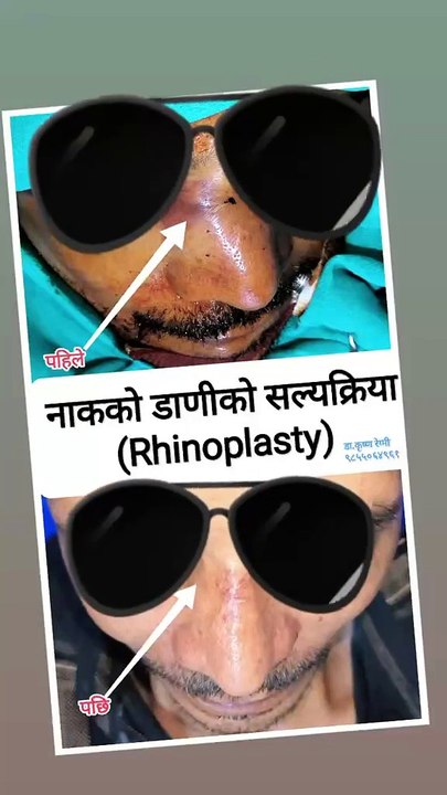 Transform Your Life with Post-Trauma Rhinoplasty