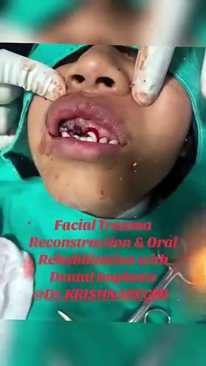 Post-Trauma Facial Reconstruction & Oral Rehabilitation with Early Implants
