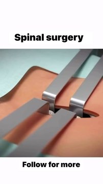 Spinal surgery