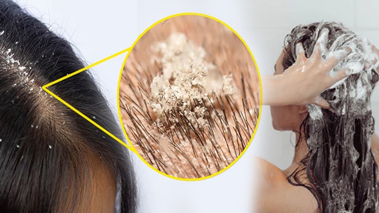 बार-बार डैंड्रफ क्यों होता है | Baar Baar Dandruff Hone Karan | Best Anti Shampoo Dandruff | Boldsky