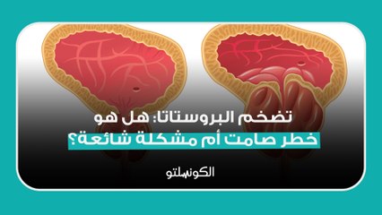 تضخم البروستاتا_ هل هو خطر صامت أم مشكلة شائعة؟