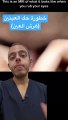 خطورة حك العينين _medicine _طب _shorts(360P)(480P)1