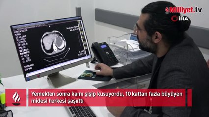 Yemekten sonra karnı şişip kusuyordu, 10 kattan fazla büyüyen midesi herkesi şaşırttı