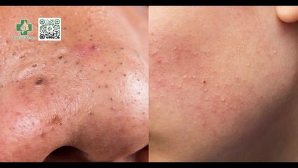 Các loại mụn li ti thường gặp và cách xử lý tốt nhất