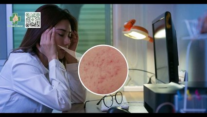 Thức khuya có nổi mụn không? Giải đáp từ chuyên gia