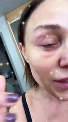 Με πρησμένο μάτι η Πηνελόπη Αναστασοπούλου: «Όποιος με καταράστηκε, συγχαρητήρια, τα κατάφερε»