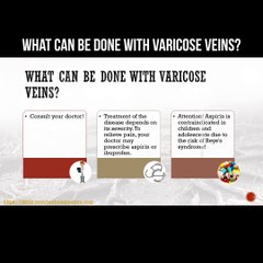 What can be done with varicose veins?